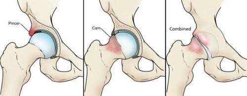 hip impingement anatomy