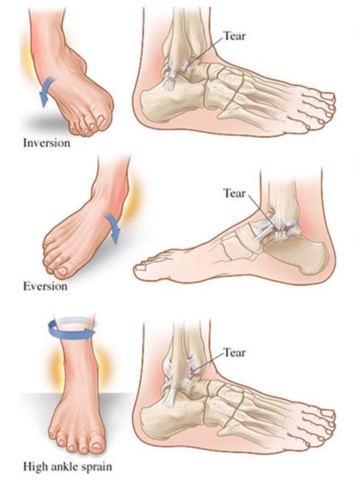 Sprained Ankles, Types, Causes & Recovery Time