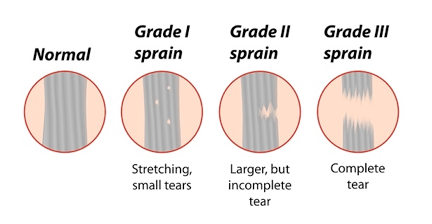 Ligament sprain classification by grade