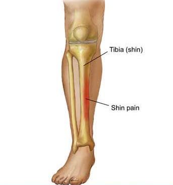 How to Tell if You Have Shin Splints and How to Recover — Oregon Running  Clinic