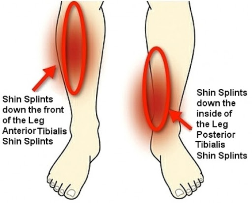 The Fix for Shin Splints That Most People Miss – ACL Strong