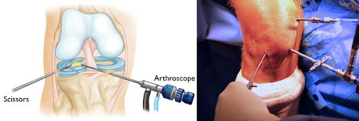 Arthroscopy